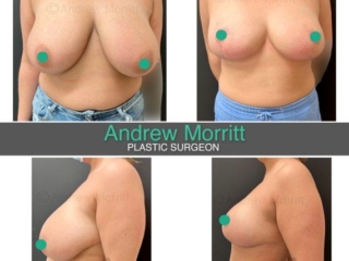 Breast reduction
