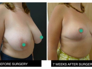 Breast reduction