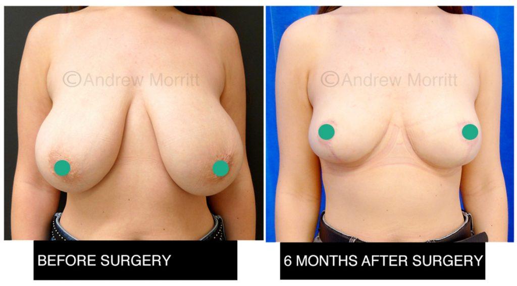 Breast reduction Breast reduction