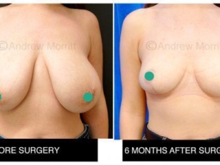 Breast reduction