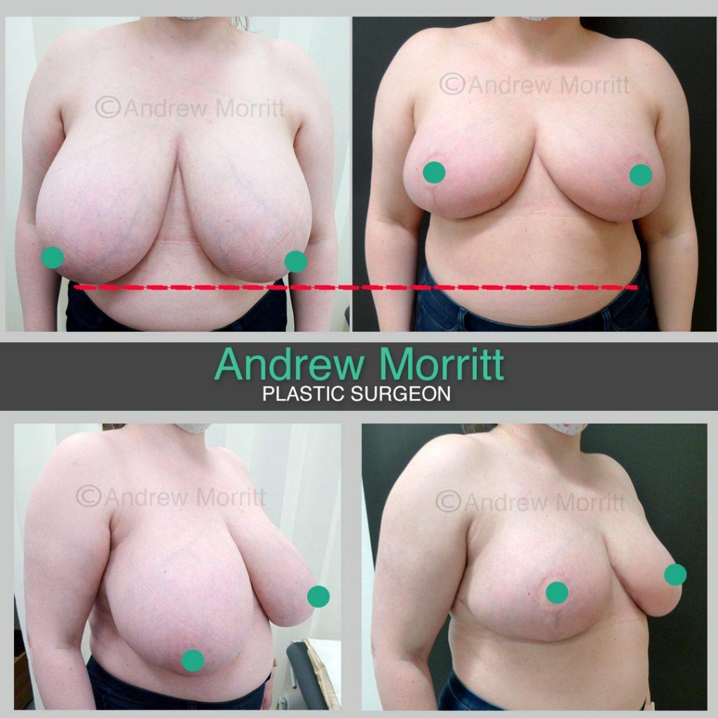 Breast reduction Breast reduction