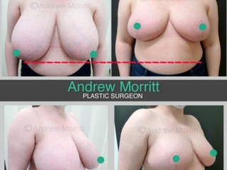 Breast reduction