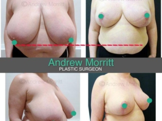 Breast reduction
