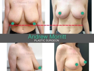 Breast reduction