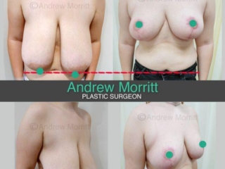 Breast reduction