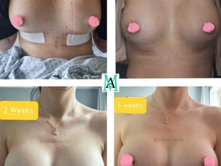 healing after breast augmentation drop and fluff 1 breast augmentation enlargement sheffield
