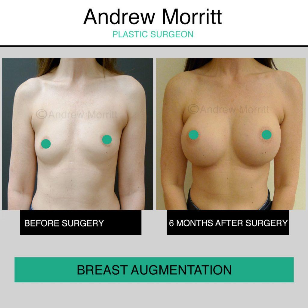 breast augmentation enlargement sheffield 4 breast augmentation enlargement sheffield