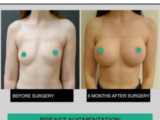 breast augmentation enlargement sheffield 4 breast augmentation enlargement sheffield