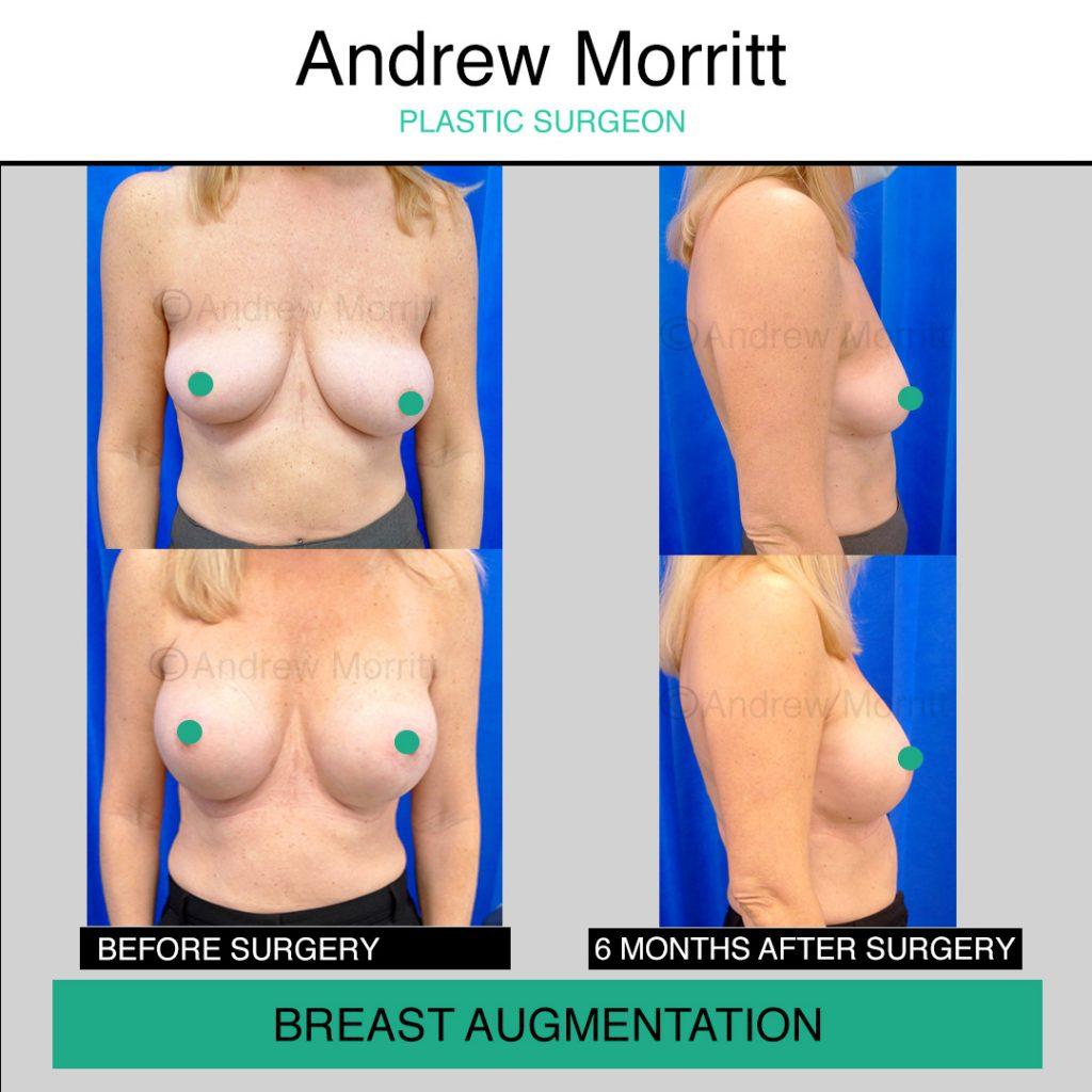 breast augmentation enlargement sheffield 5 breast augmentation enlargement sheffield