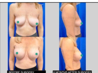 breast augmentation enlargement sheffield 5 breast augmentation enlargement sheffield