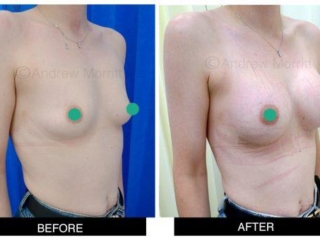 breast augmentation enlargement sheffield 3 breast augmentation enlargement sheffield