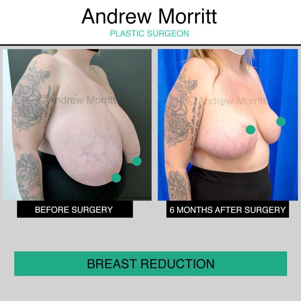 Breast reduction Breast reduction