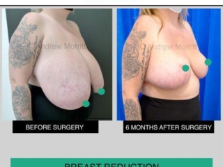 Breast reduction