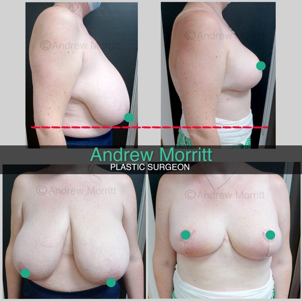 Breast reduction Breast reduction