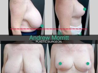 Breast reduction
