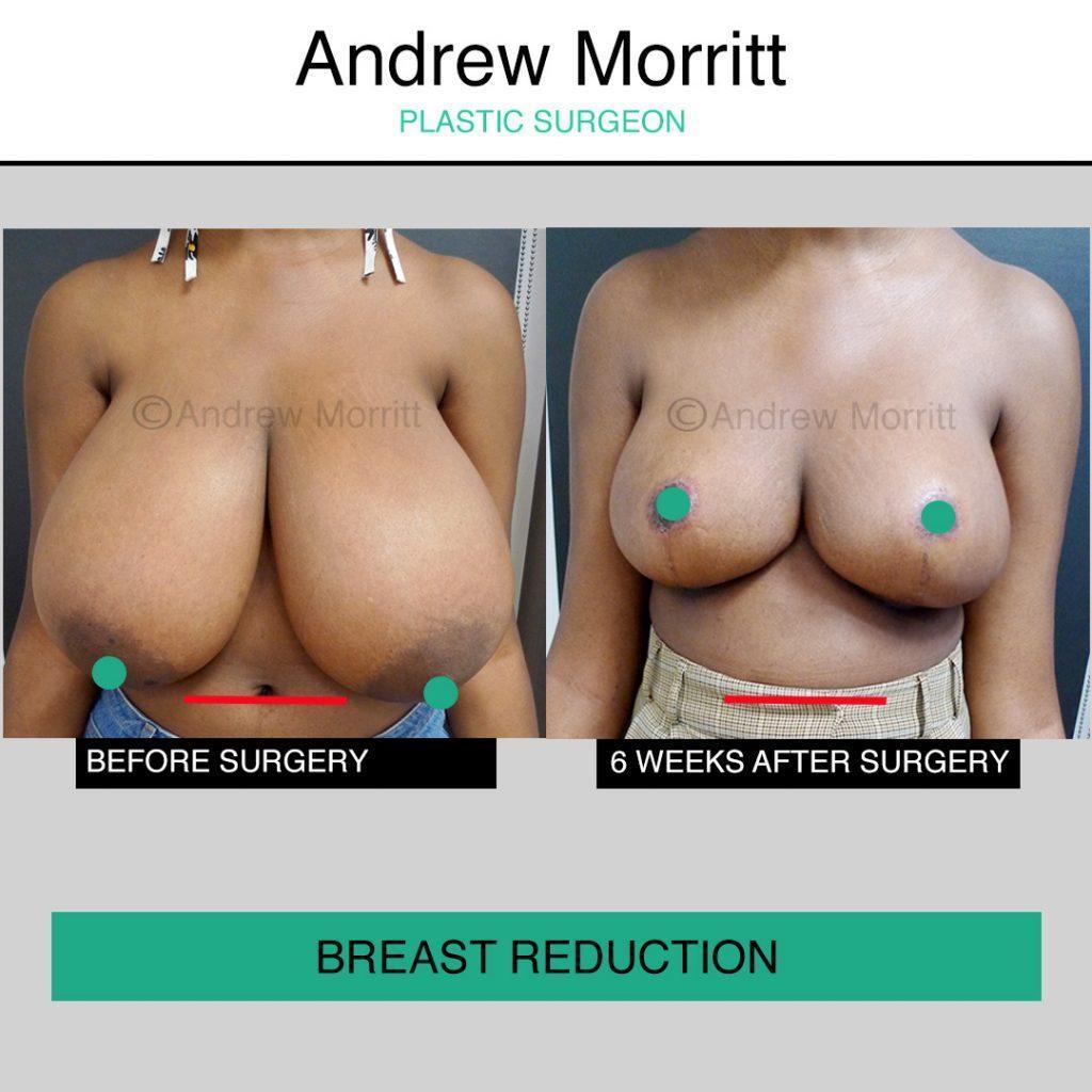 Breast reduction Breast reduction