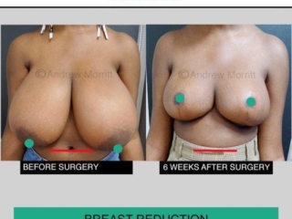 Breast reduction