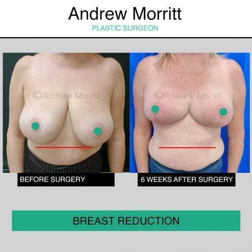 breast reduction uplift