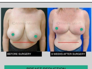 Breast reduction