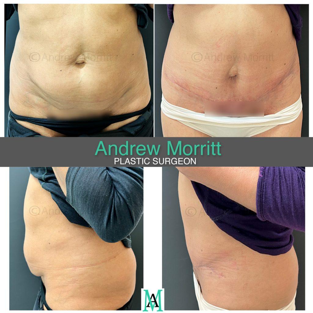 appearances before and after mini tummy tuck