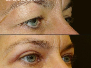 Upper blepharoplasty eyelid surgery Sheffield