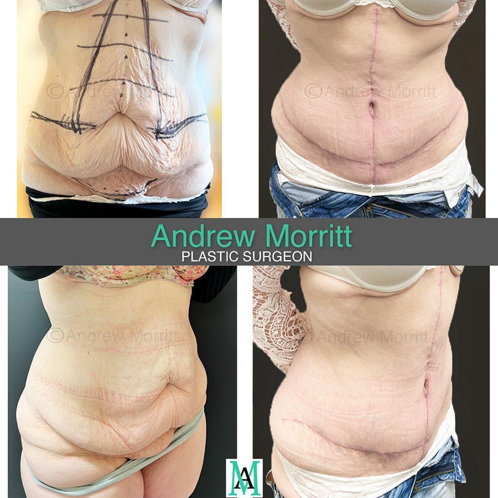 fleur de lys tummy tuck mons reduction