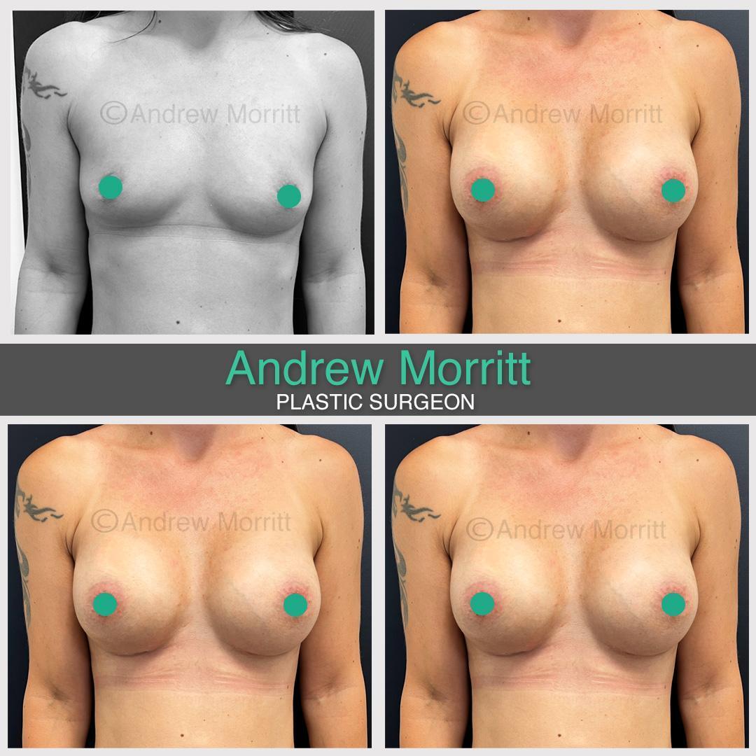 appearances before and after breast augmentation
