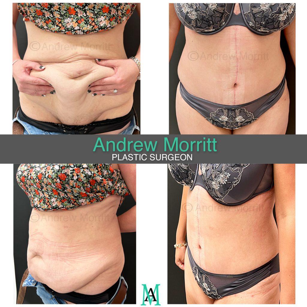 photos showing appearances after fleur de lys abdominoplasty and liposuction sheffield