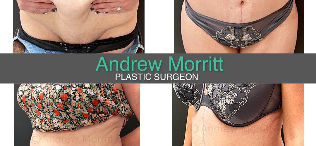 FDL abdominoplasty tummy tuck