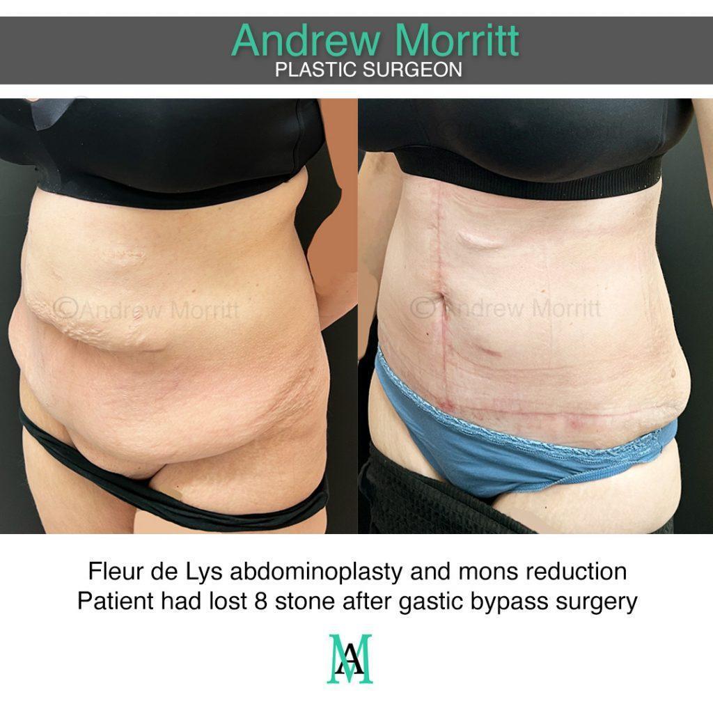 photos showing appearances before and after tummy tuck and mons reduction