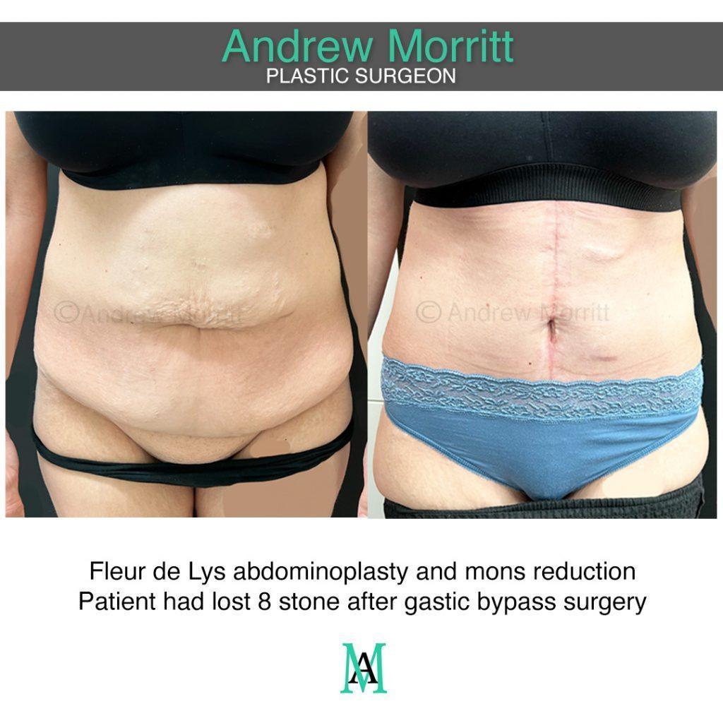 photos showing appearances tummy tuck and mons reduction