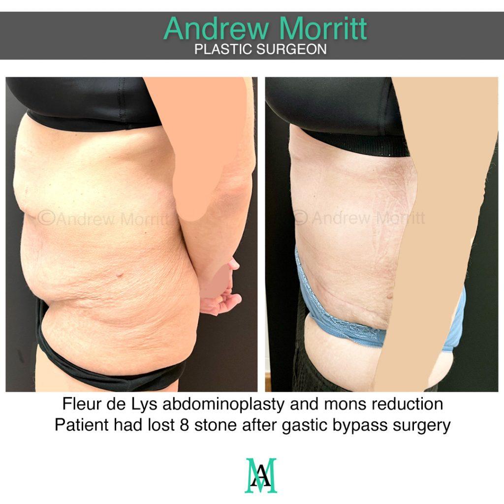 photos showing appearances tummy tuck and mons reduction