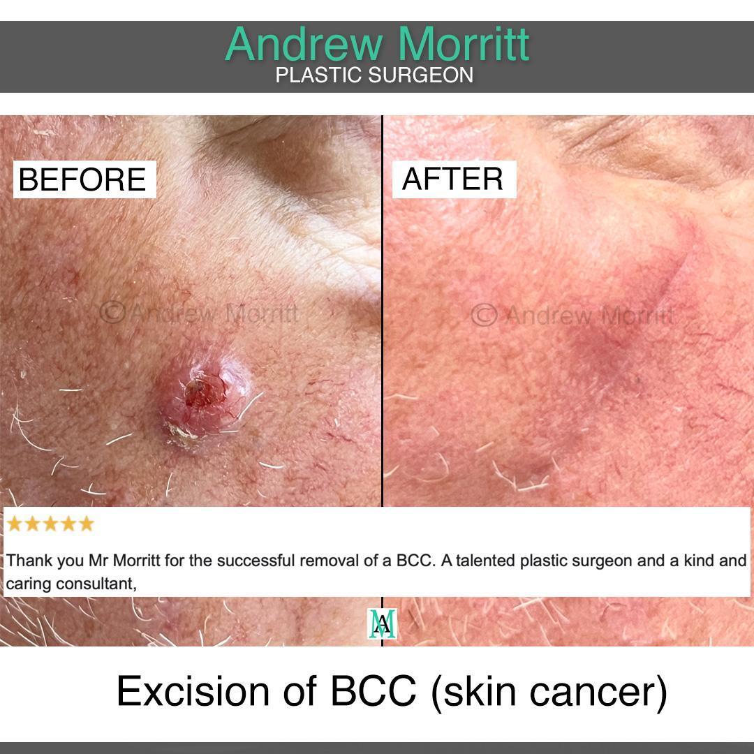 BCC skin cancer treatment sheffield
