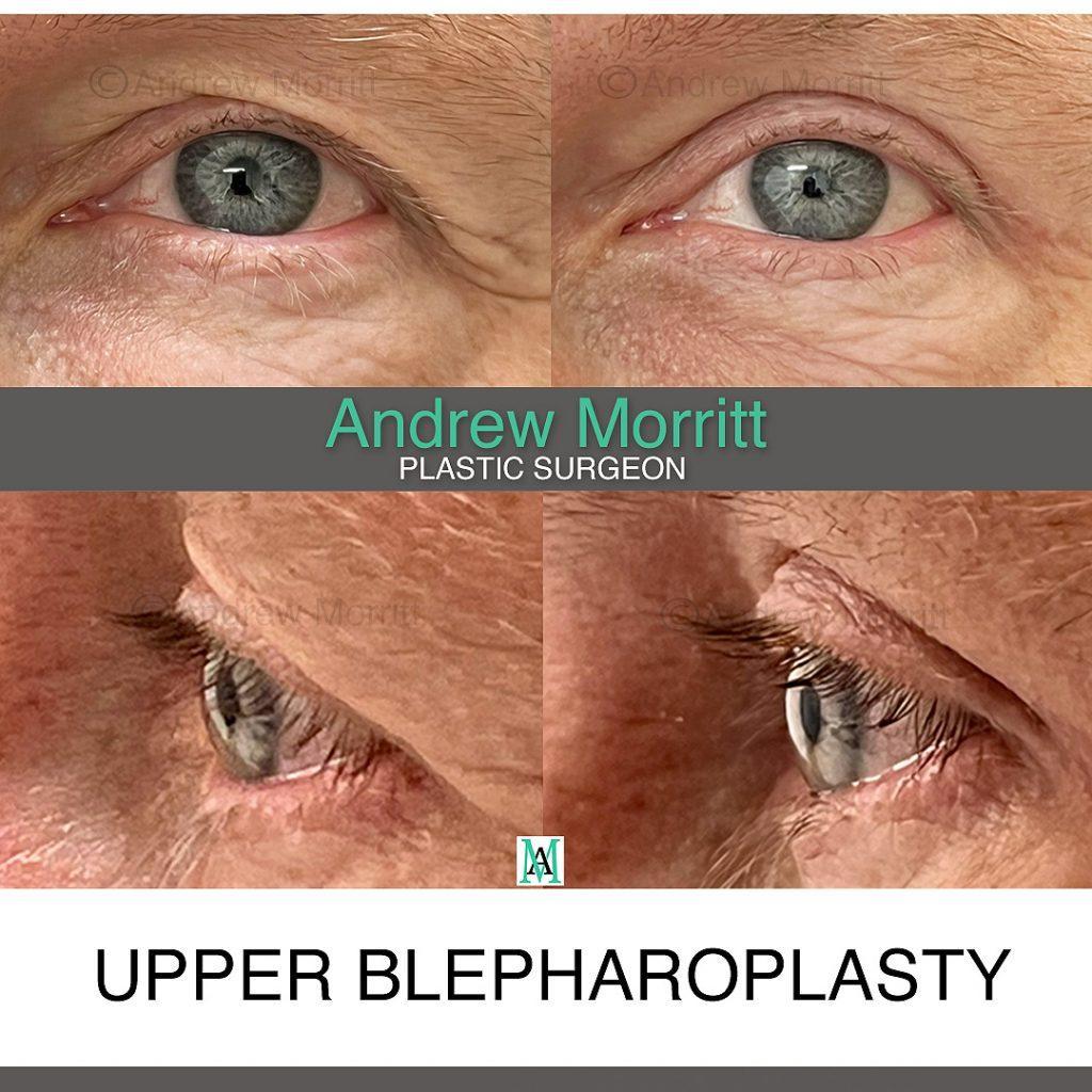 blepharoplasty8a before and after upper blepharoplasty eyelid lift