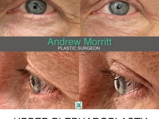 before and after upper blepharoplasty eyelid lift