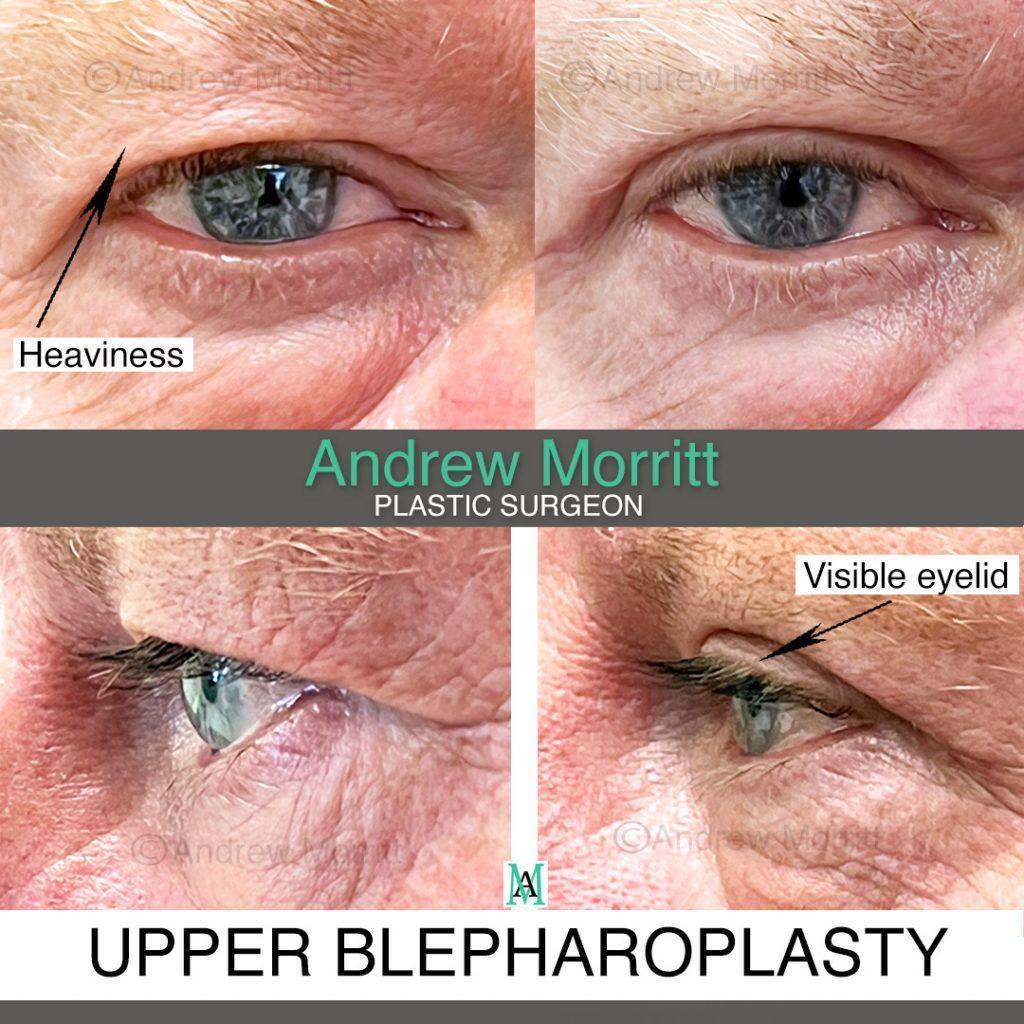 blepharoplasty9 blepharoplasty upper eyelid surgery