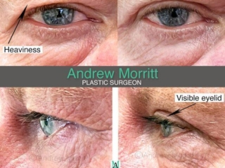 blepharoplasty upper eyelid surgery