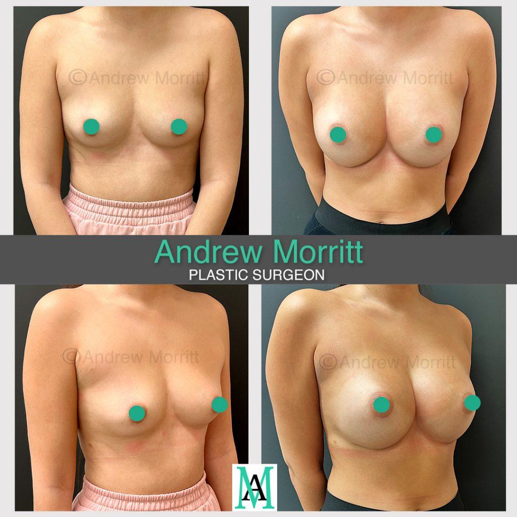 breast-augmentation-23 appearances before and after breast augmentation