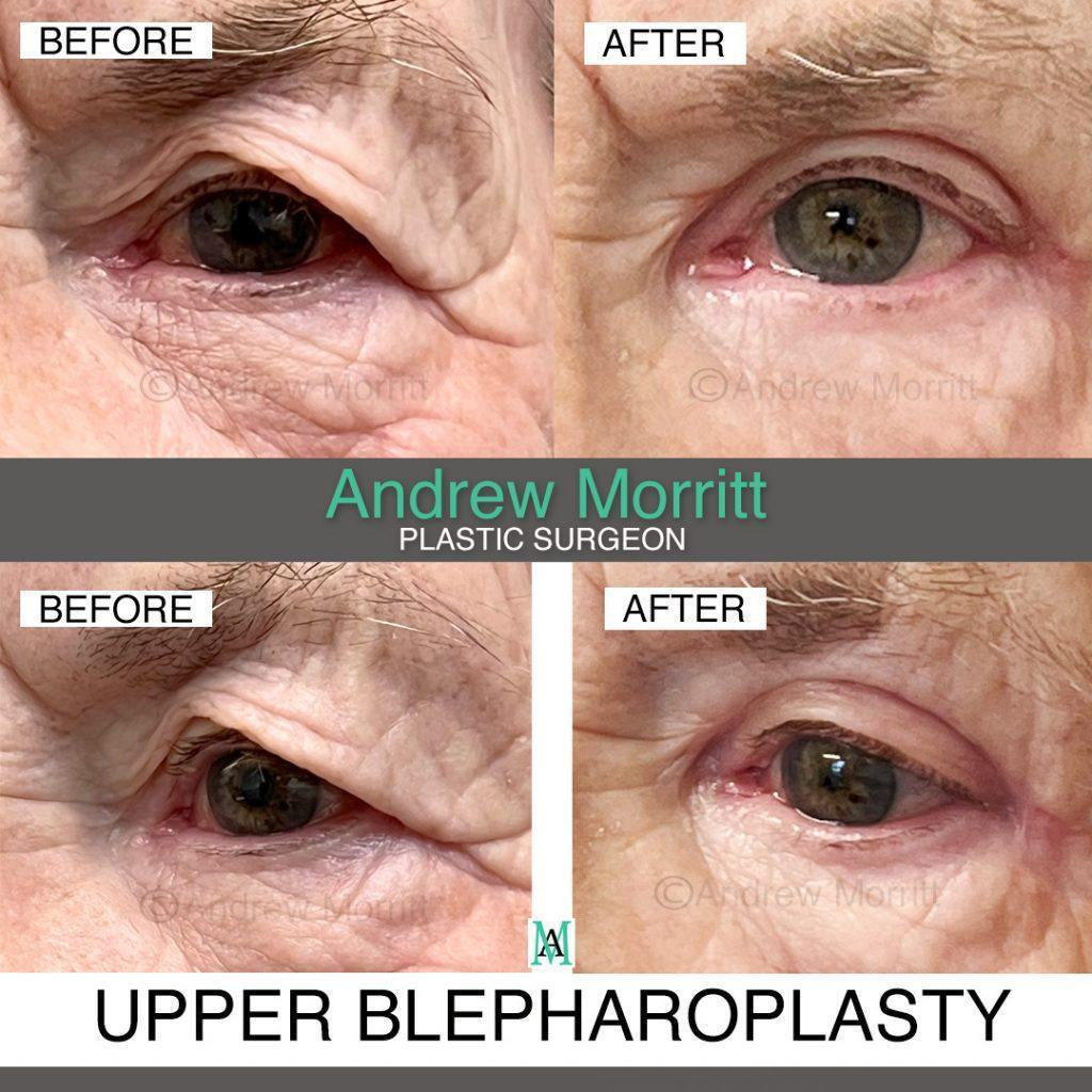 blepharoplasty10 upper eyelid blepharoplasty surgery