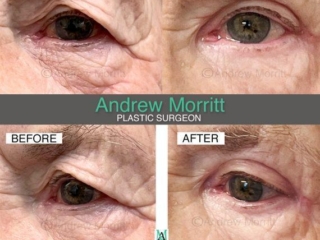 upper eyelid blepharoplasty surgery