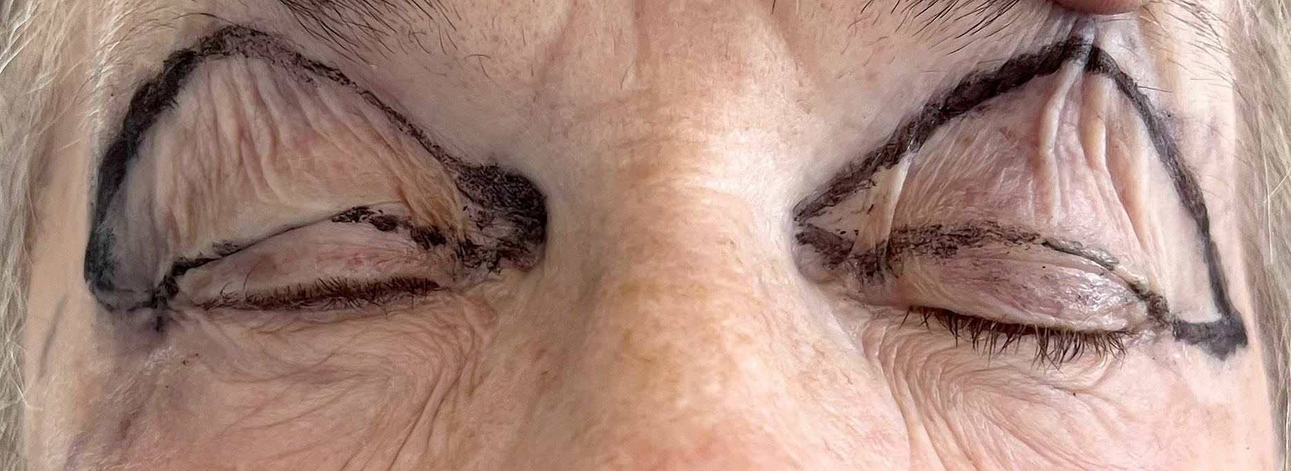 upper eyelid blepharoplasty surgery