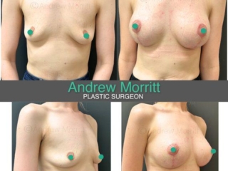 breast-augmentation-mastopexy-5 breast implants augmentation and uplift mastopexy