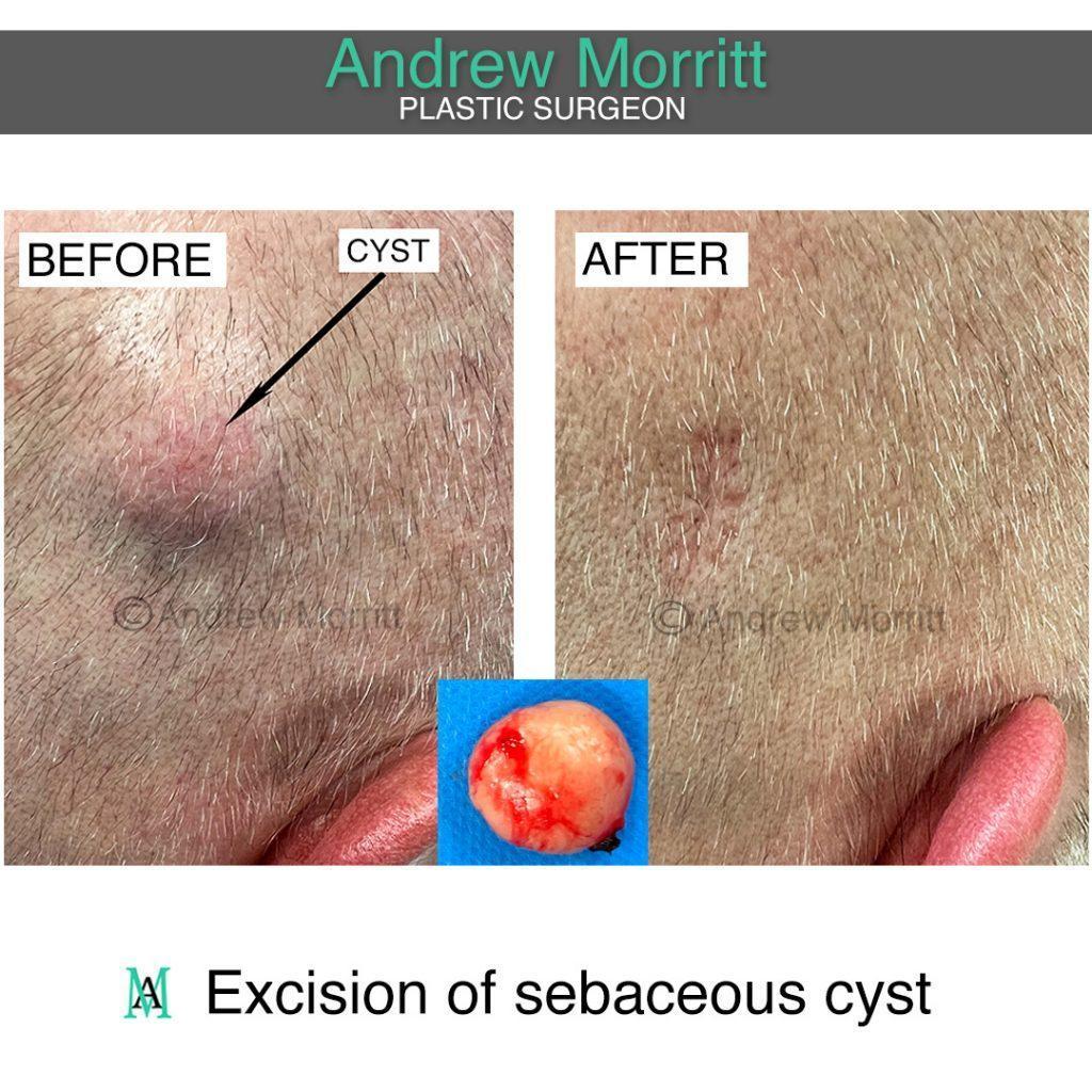 sebaceous cyst removal 