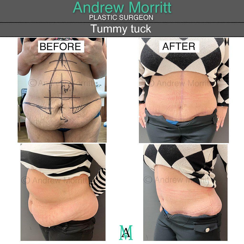 fleur-de-lys FDL tummy tuck