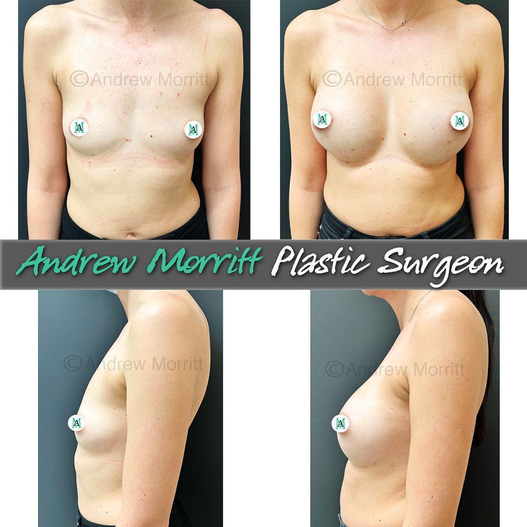 breast-augmentation-24 breast augmentation photos