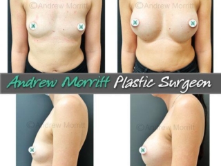 breast-augmentation-24 breast augmentation photos