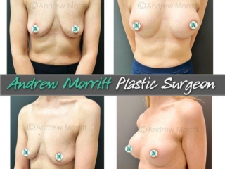 breast-augmentation-25 breast augmentation photos