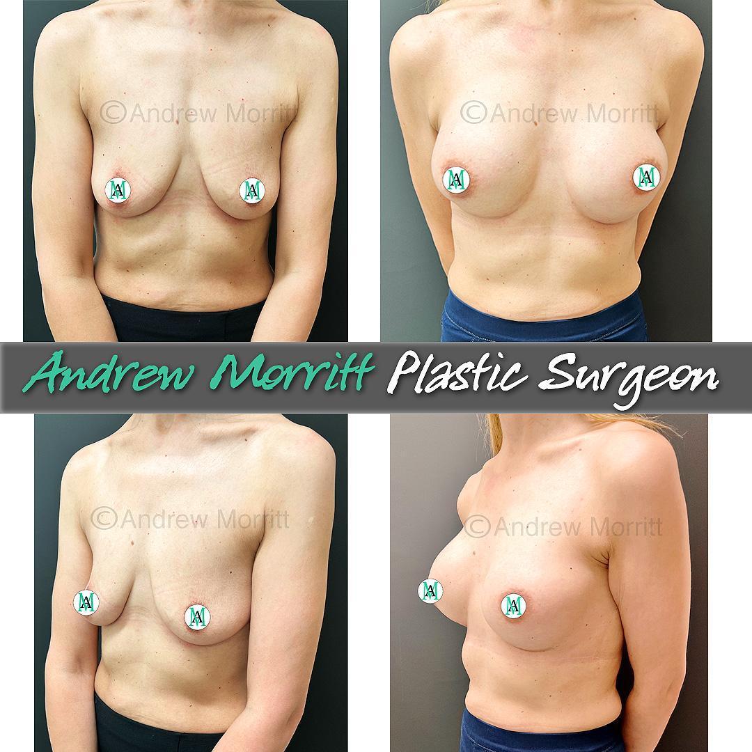 breast augmentation photos