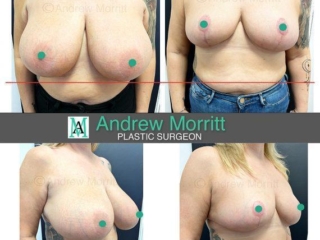 breast reduction