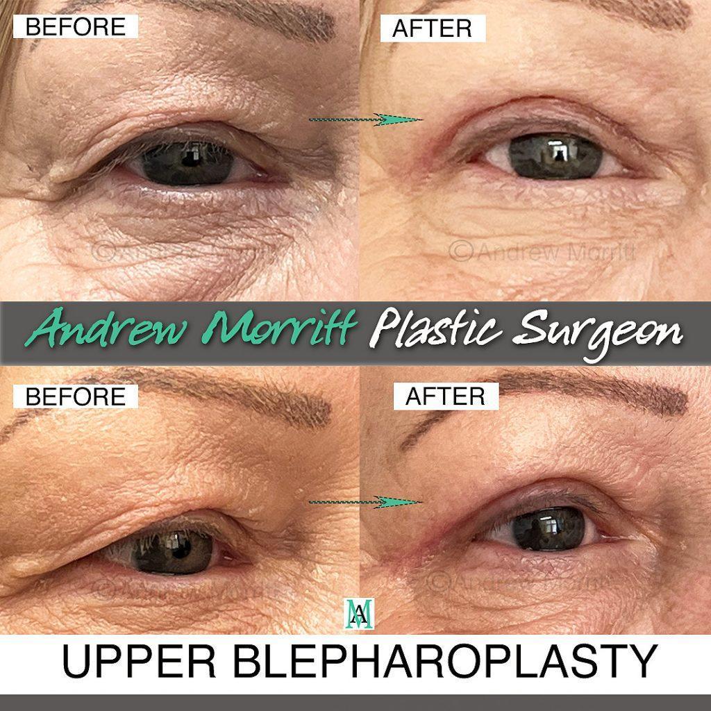 blepharoplasty11 upper eyelid lift surgery